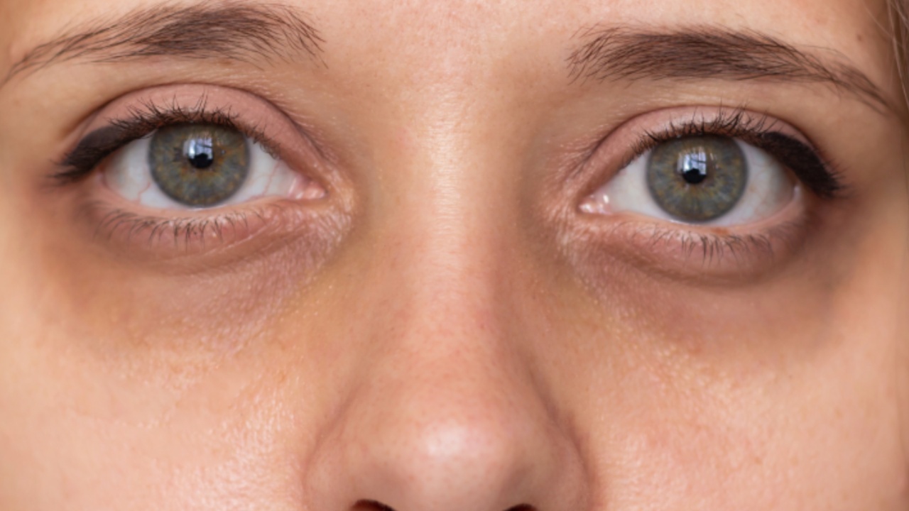 Dark Circles