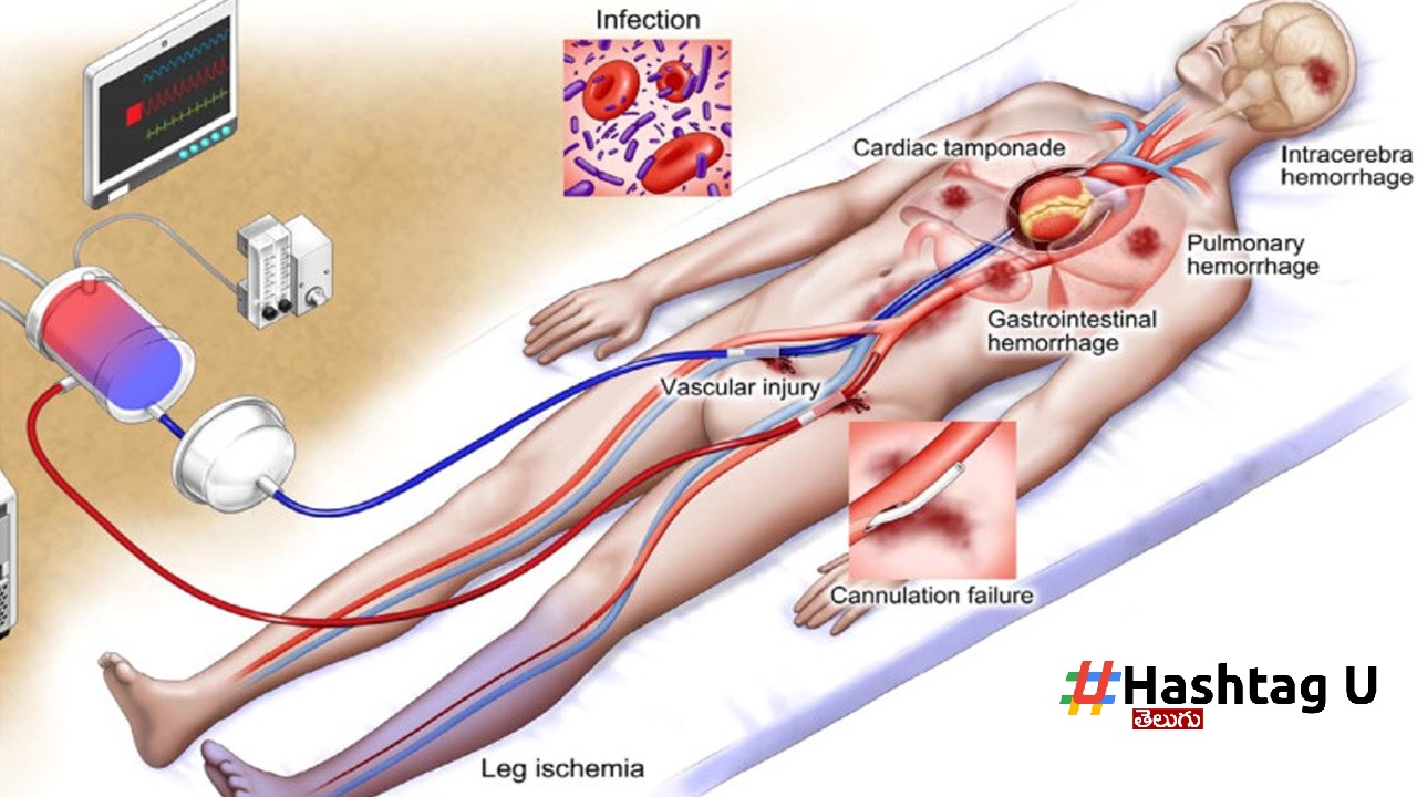 Ecpr Treatment