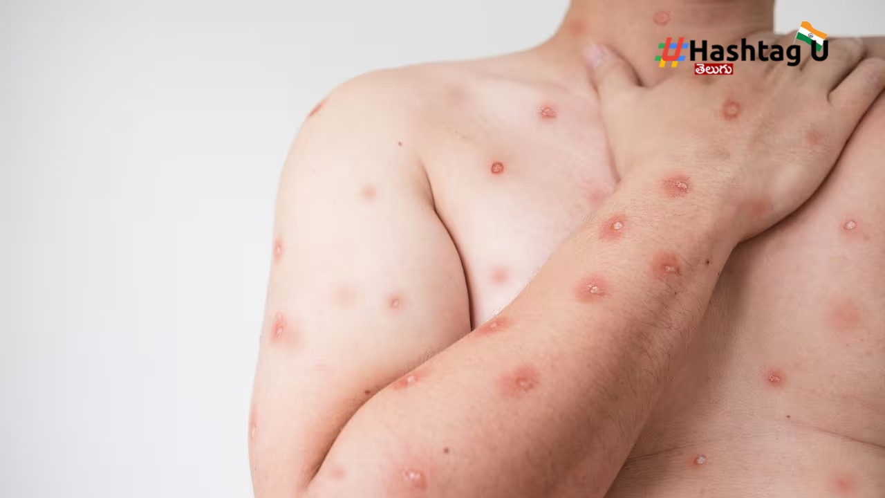 Monkeypox