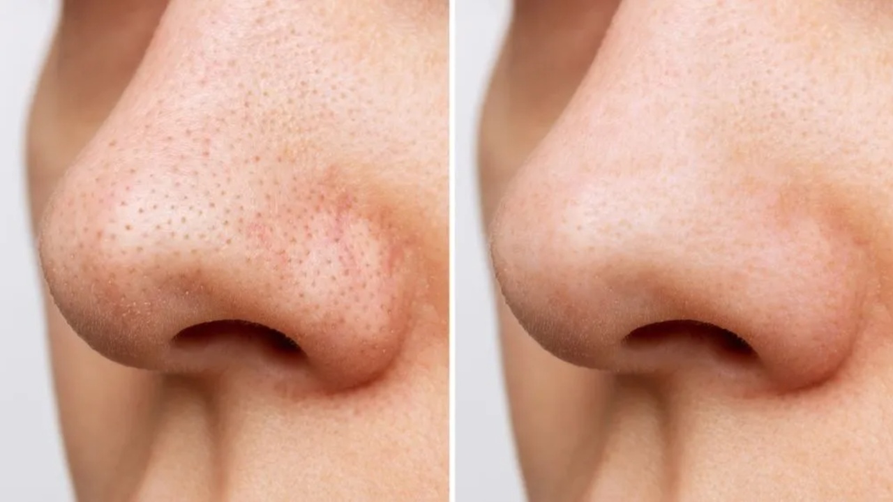 Black Heads