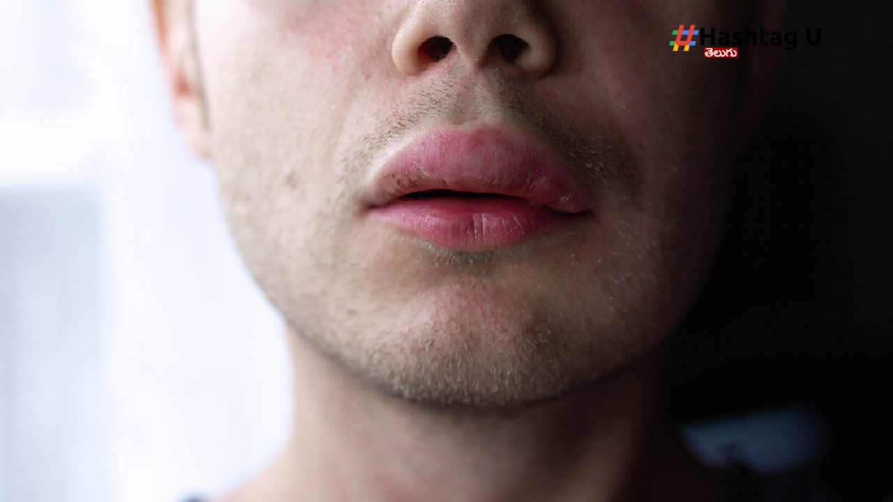 Lip Cancer