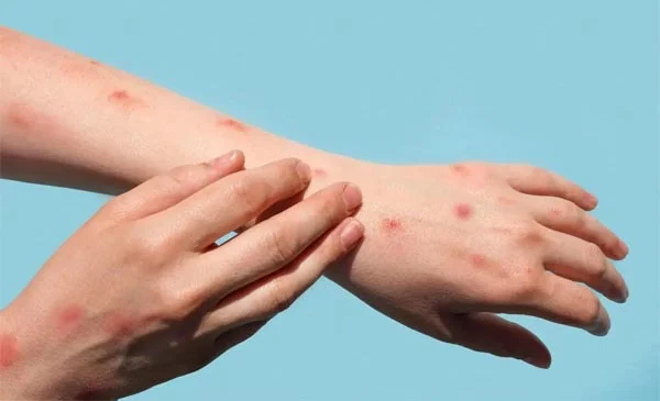Monkey Pox