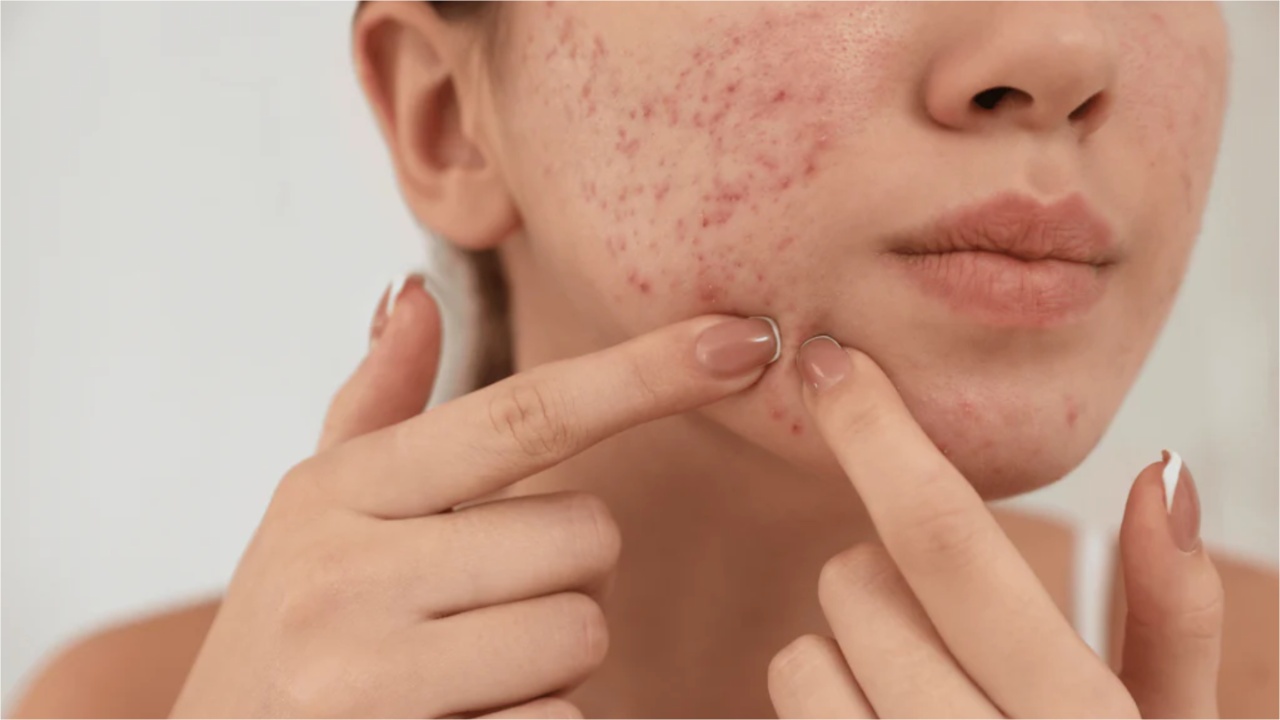 Pimples