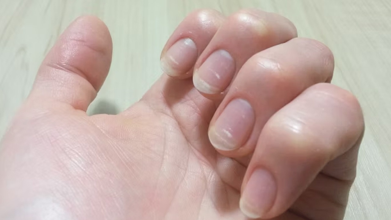 White Spots On Nails
