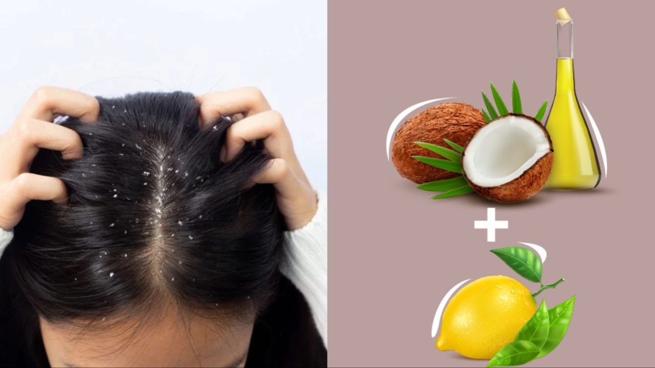 Dandruff