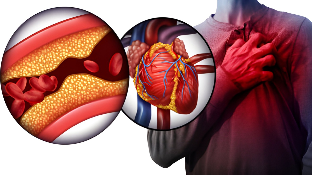 Heart Block