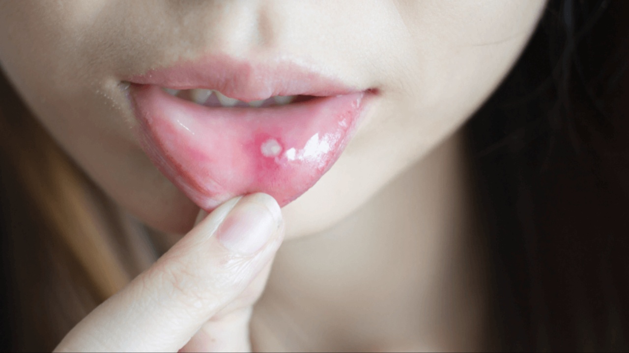 Mouth Ulcers