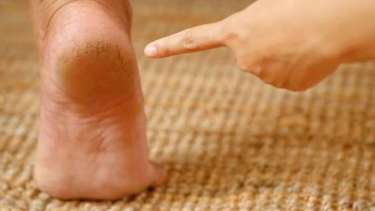 Cracked Heels
