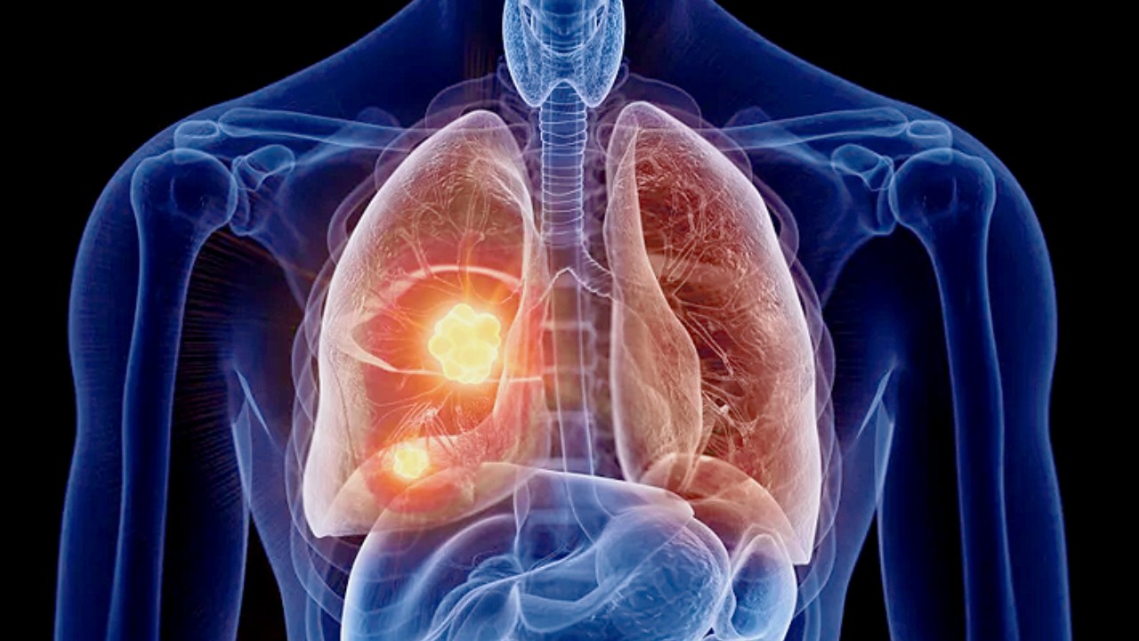 Lung Cancer Vs Lung Tumor