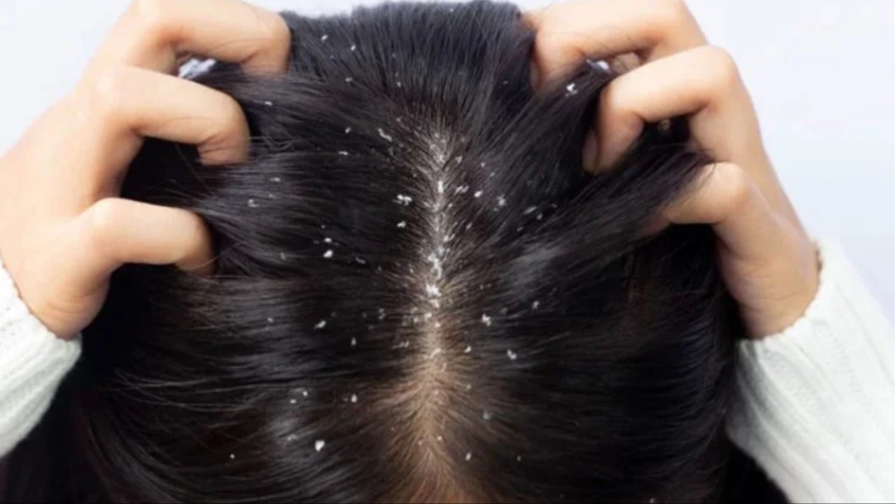 Dandruff