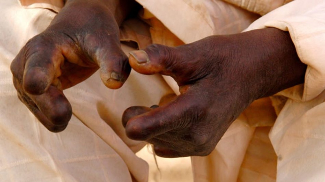 Leprosy