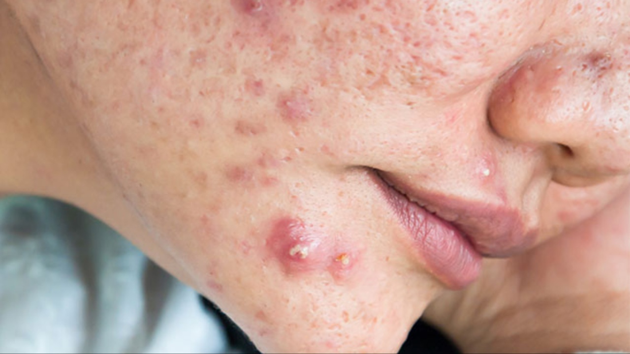 Pimples