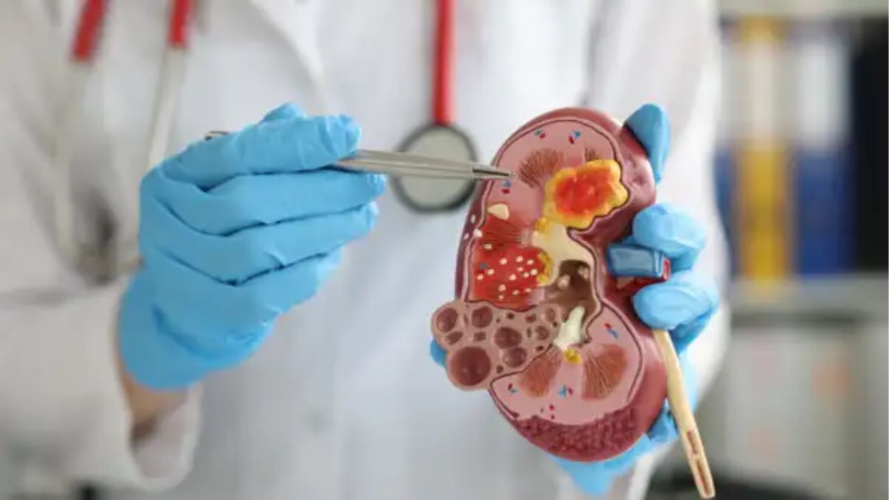 Kidney Stones: కిడ్నీలో రాళ్ల సమస్య.. షాకింగ్ విషయాలు వెలుగులోకి Kidney Stones Risks Facts Delhi Aiims Research