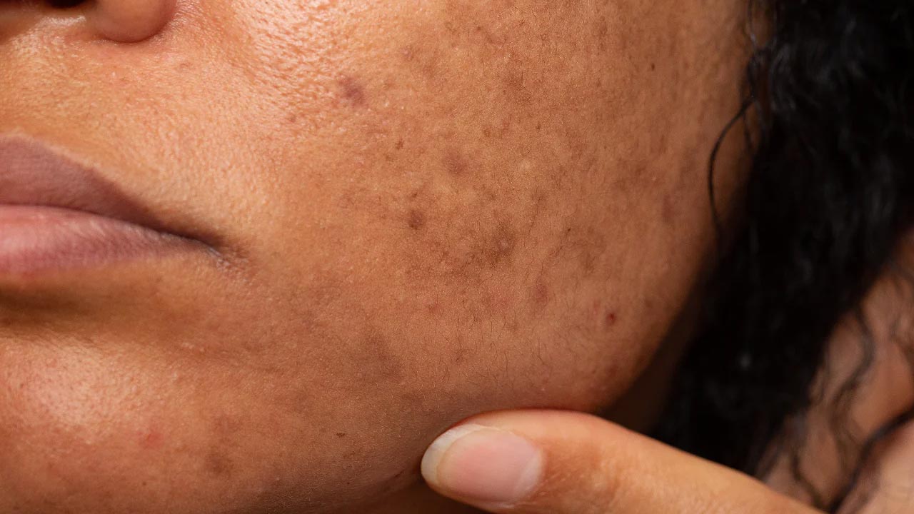 Pigmentation