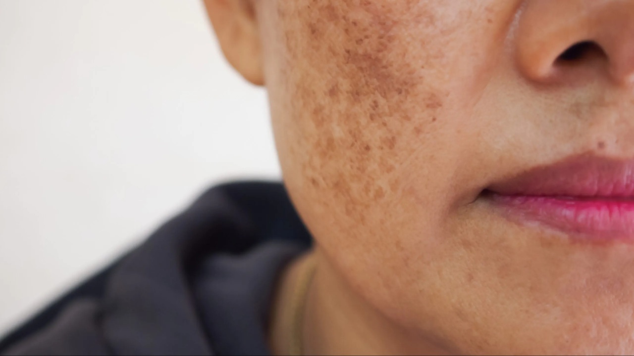 Pigmentation