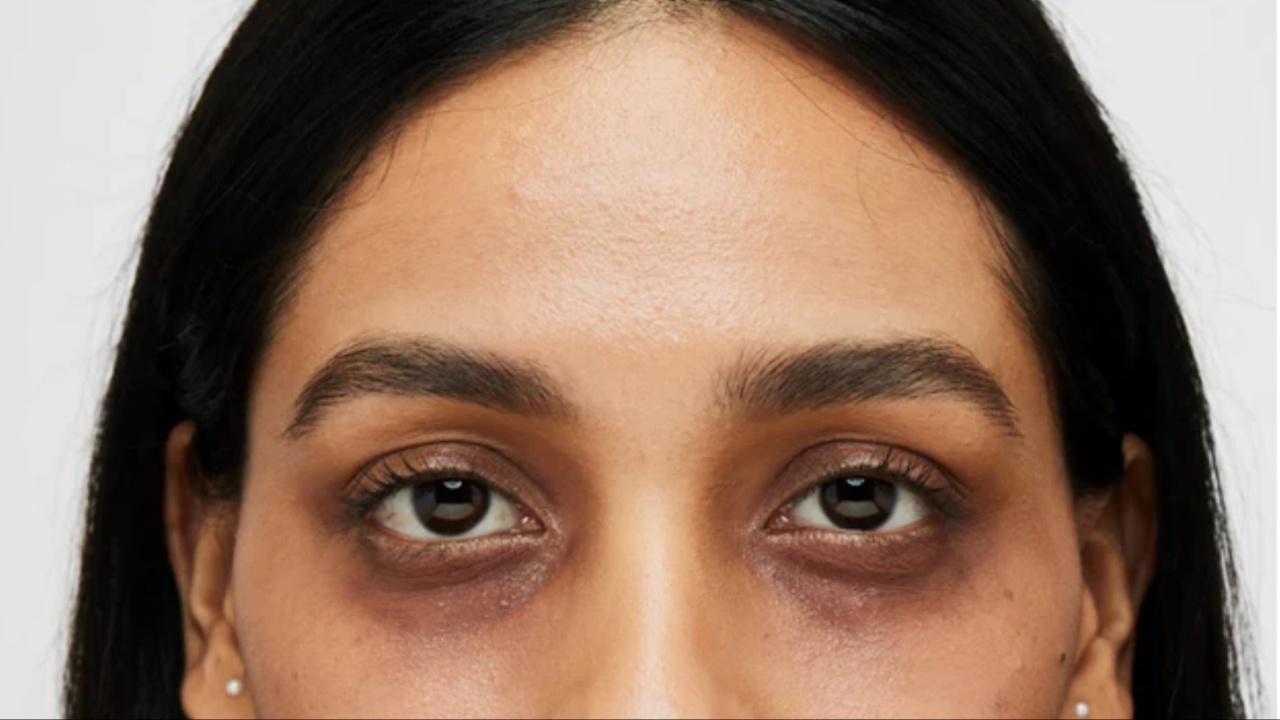 Dark Circles