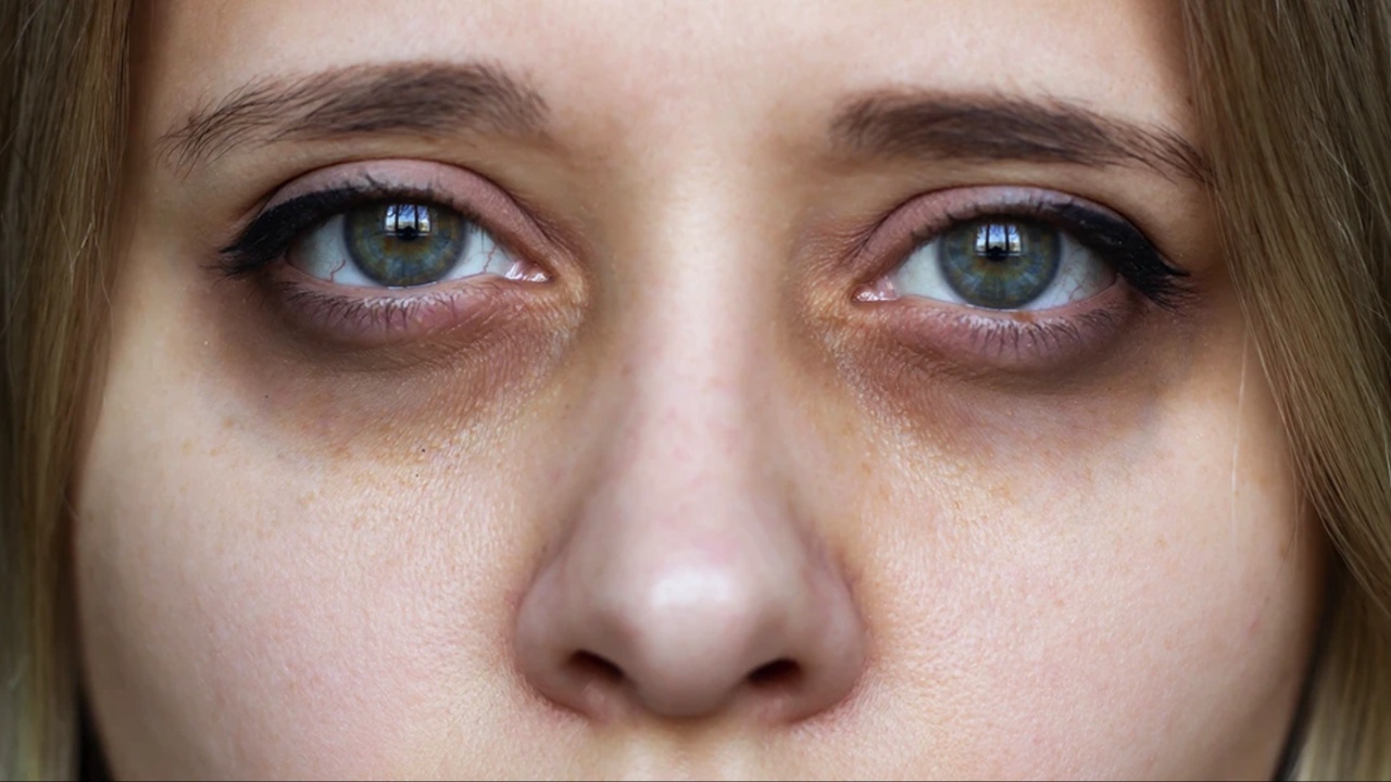 Dark Circles