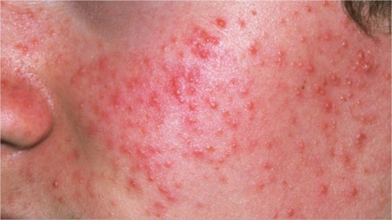 Pimples