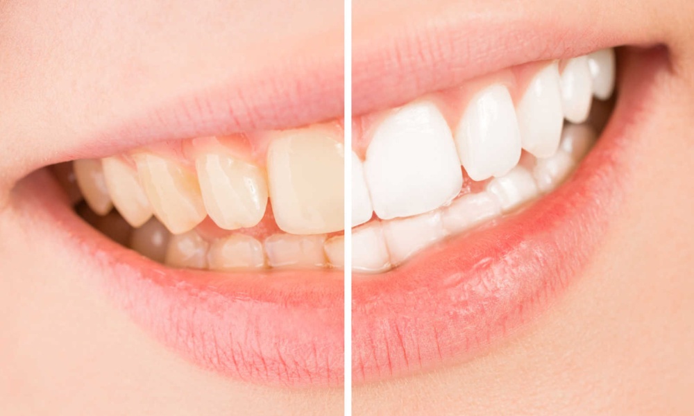 Yellow Teeth