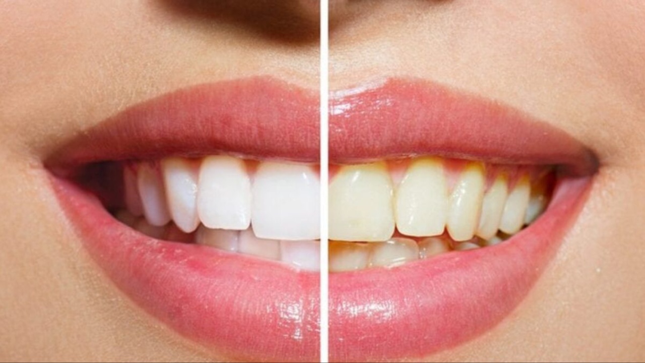 Yellow Teeth