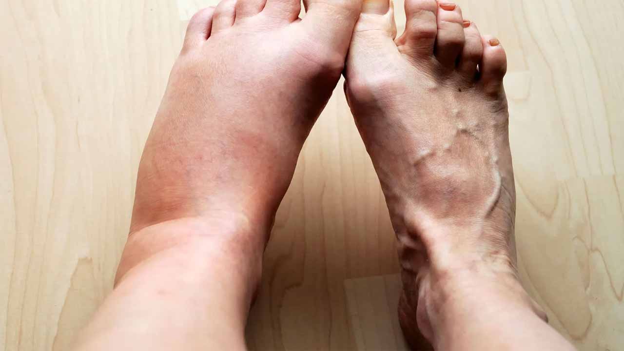 Swelling in the feet..is it normal? Or is it a serious problem? Experts warn