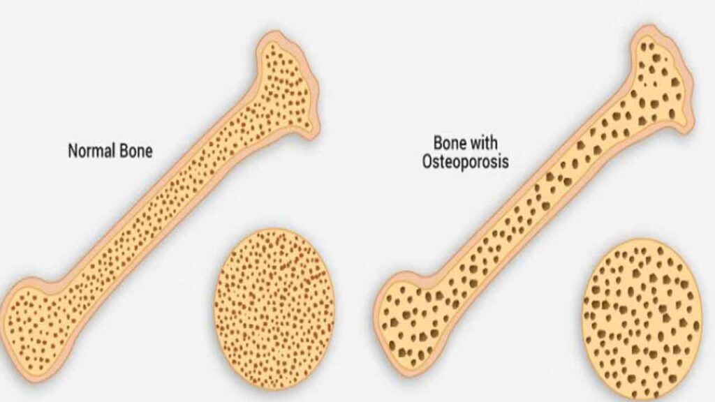 Bone Density
