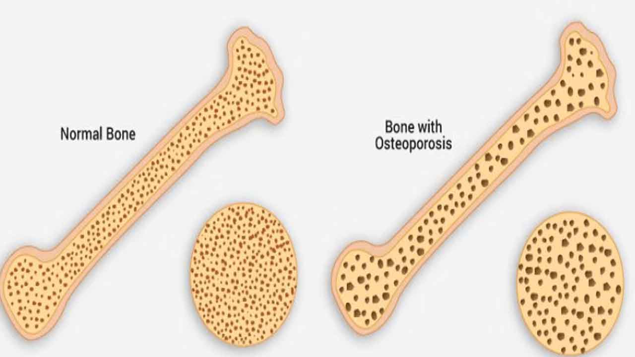 Bone Density