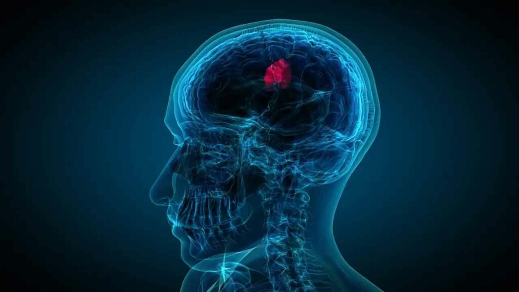 Clot In Brain