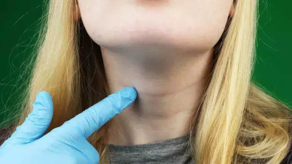 Hypothyroidism