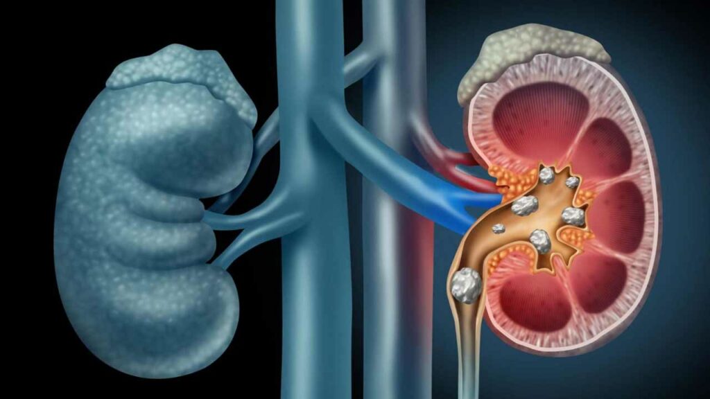 Kidney Stones