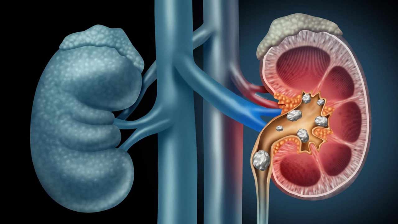 Kidney Stones