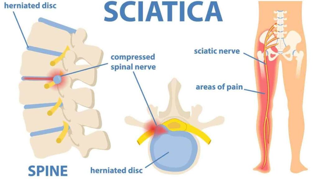 Sciatica