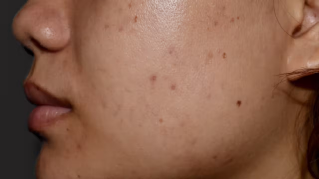 Black Spots