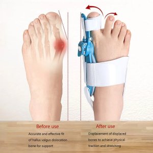 Bunion Support Splint Valgus Corrector