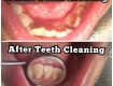 Get 20% Off On Teeth Cleaning