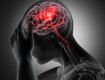 cervical spine surgery in Gurgaon