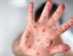 Treatment of Monkeypox Symptoms Smallpox Drug Tecovirimat