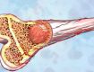 Bone Marrow Cancer Treatment in Lucknow
