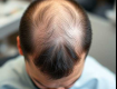 Hair Transplant Price