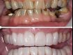 Best Teeth Whitening Treatment in South Delhi | Elite Clinic