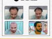 Hair Transplant at 19,999