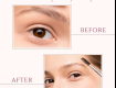 Eyebrow Lift Surgery In Lucknow