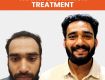 Advanced Hair Transplant & Hair Fall Treatments in Kochi