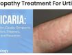 Homeopathy Treatment For Urticaria