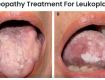 Homeopathy Treatment For Leukoplakia