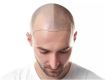 Masters Course in Hair Transplantation