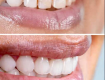 Dental Veneers Near Oshiwara