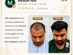 Hair Transplant in Mira Road