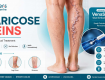 Varicose veins