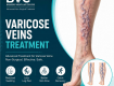 Varicose-veins